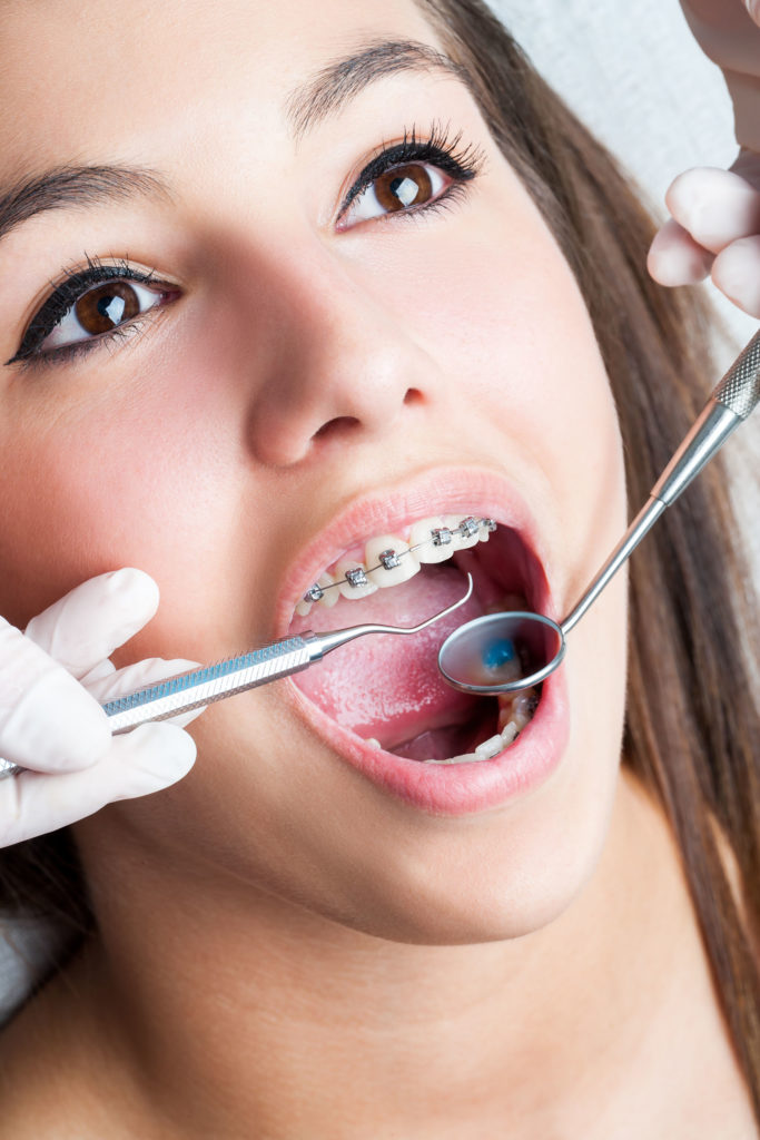 Patiente ouvre la bouche pour une contrôle orthodontique avec l'orthodontiste.